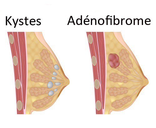 adenofibrome du sein