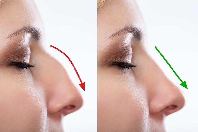  rhinoplastie chirurgie esthétique avant après