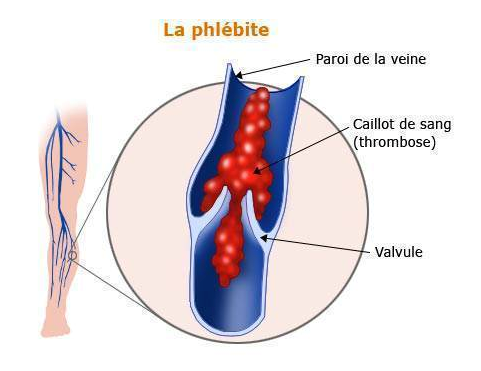 phlébite