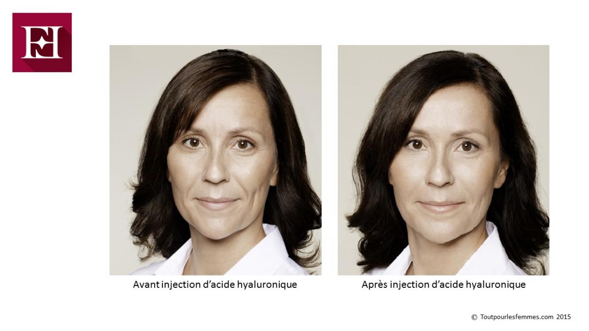 Acide hyaluronique avant et après