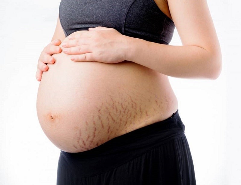 vergetures, femme enceinte